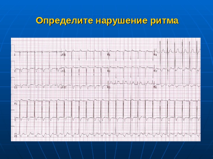   Определите нарушение ритма 