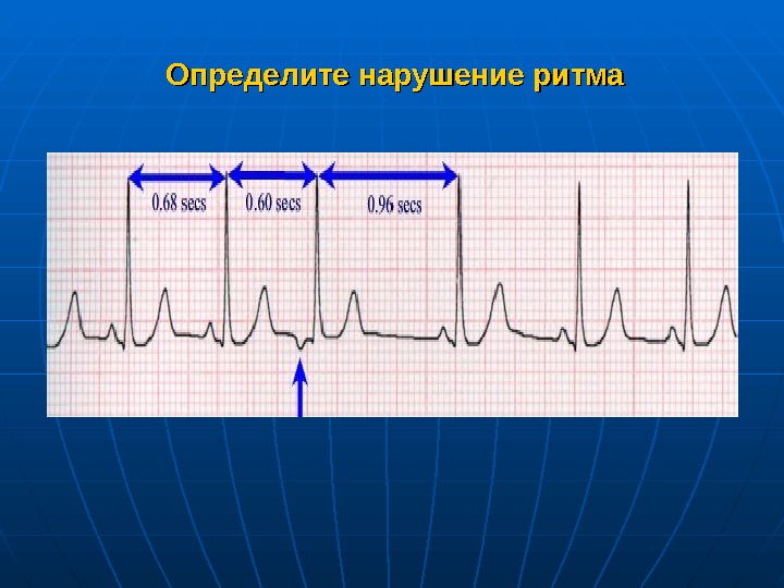   Определите нарушение ритма 