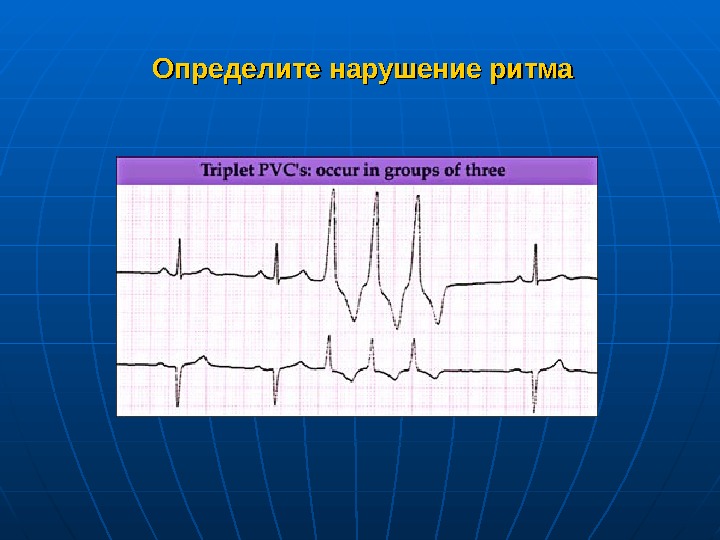   Определите нарушение ритма 