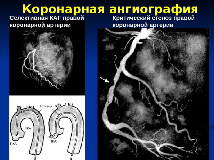28 Селективная КАГ правой коронарной артерии Критический стеноз правой коронарной артерии Коронарная ангиография 