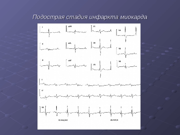 Стадии инфаркта миокарда