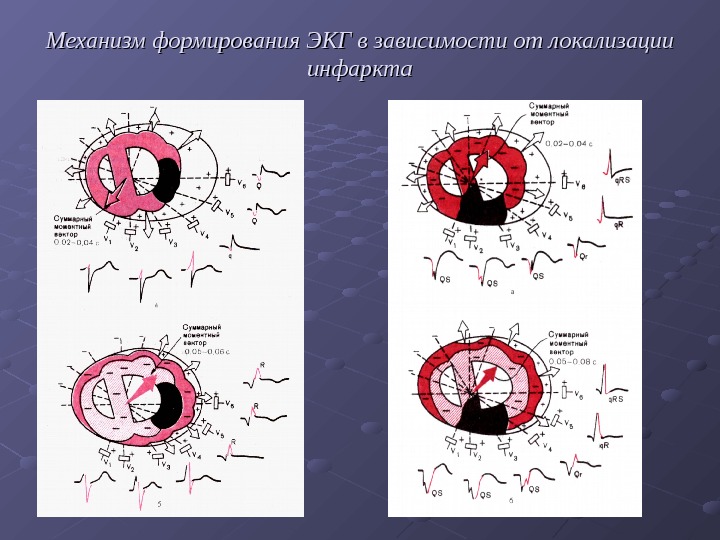 Локализация инфаркта миокарда по экг. Механизмы формирования ЭКГ. Инфаркт в зависимости от локализации. ЭКГ В зависимости от локализации инфаркта. Локализация повреждений на ЭКГ.