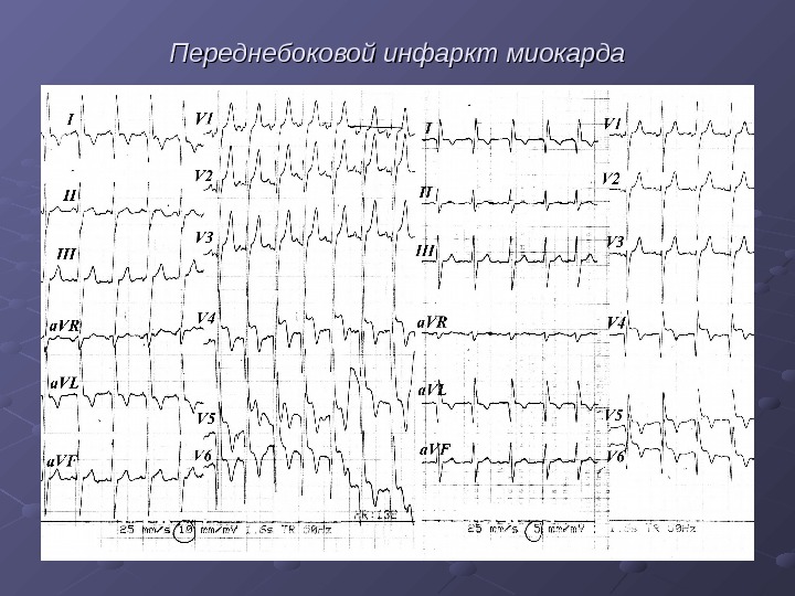 Изменение миокарда высоких боковых отделов