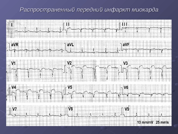 История болезни по инфаркту миокарда образец