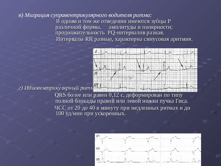 Миграция ритма. Ритм миграция водителя ритма. Миграция суправентрикулярная ритма причины. Миграция суправентрикулярного водителя ритма на ЭКГ. Синусовый ритм с эпизодами миграции водителя ритма по предсердиям.