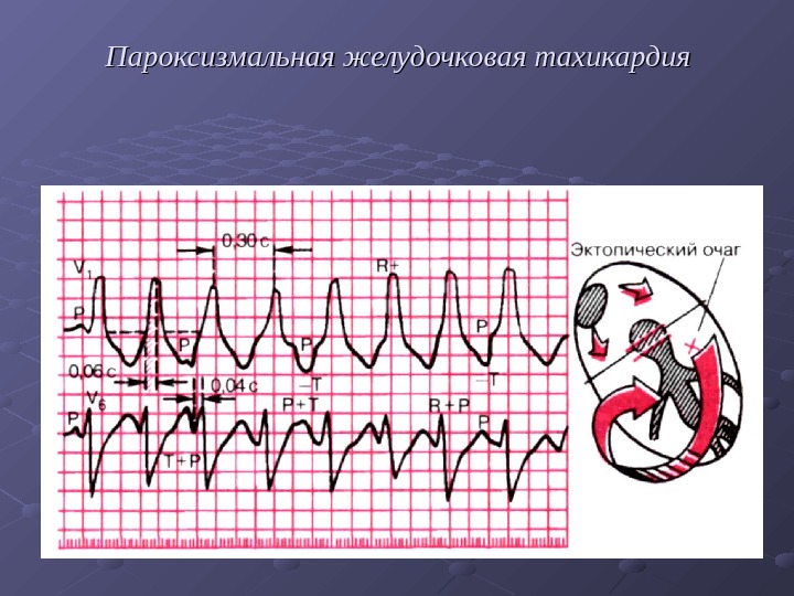 Желудочковая тахикардия картинки