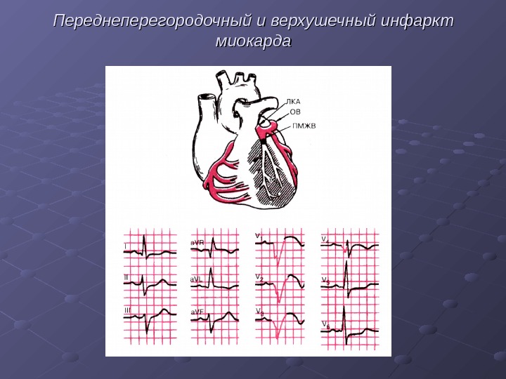   Переднеперегородочный и верхушечный инфаркт миокарда 