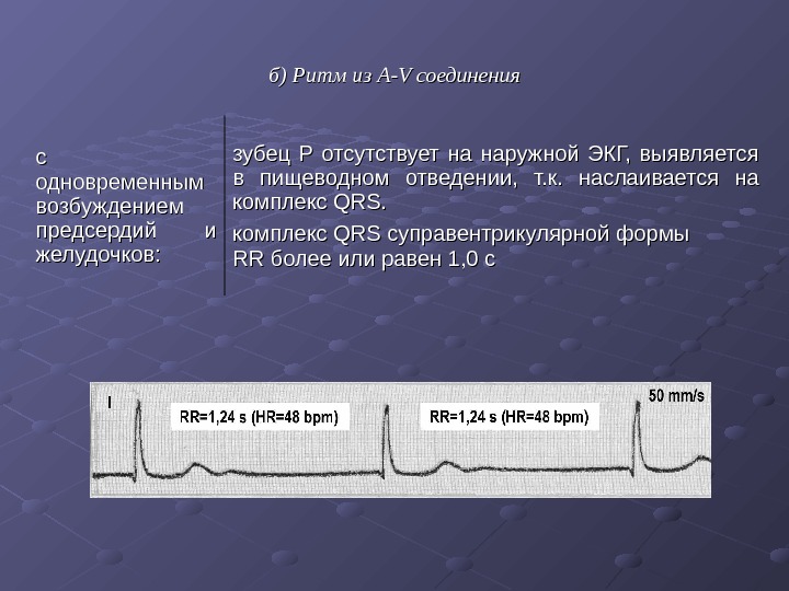   б) Ритм из А-V соединения с с одновременным возбуждением предсердий и желудочков: