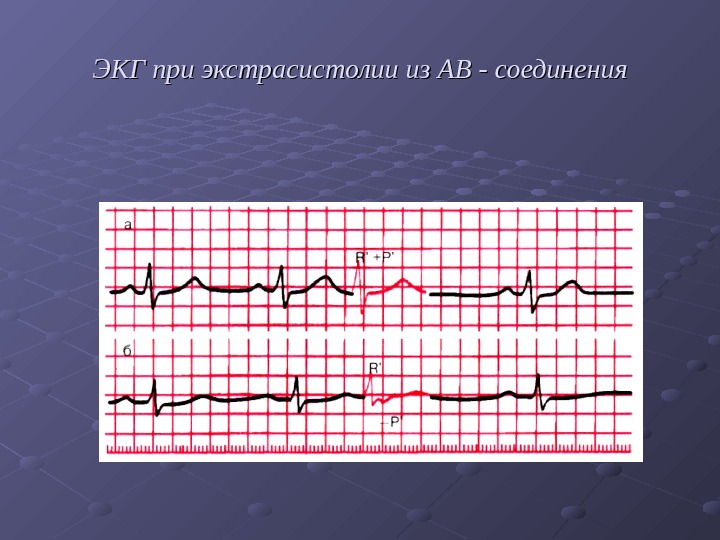  ЭКГ при экстрасистолии из АВ - соединения 