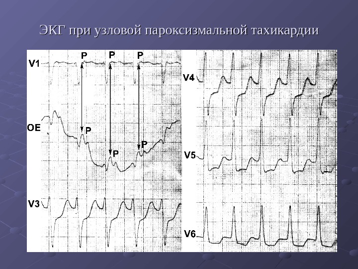   ЭКГ при узловой пароксизмальной тахикардии 