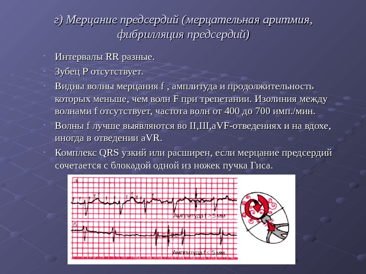   г) Мерцание предсердий (мерцательная аритмия,  фибрилляция предсердий) • Интервалы RR разные.