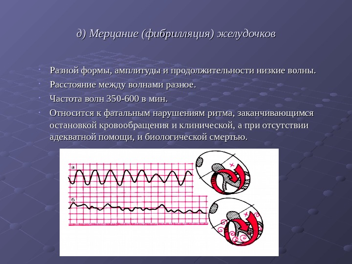   д) Мерцание (фибрилляция) желудочков • Разной формы, амплитуды и продолжительности низкие волны.