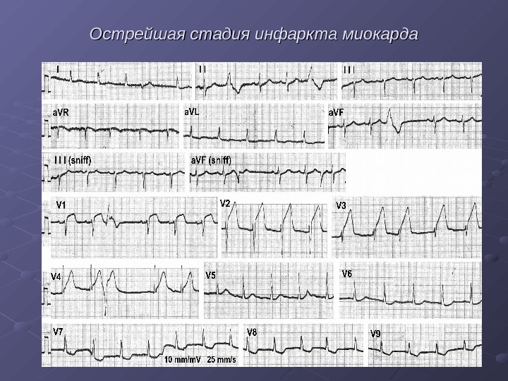   Острейшая стадия инфаркта миокарда 