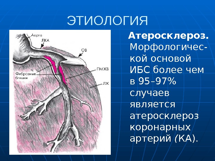 ЭТИОЛОГИЯ  Атеросклероз.  Морфологичес- кой основой ИБСболее чем в 95– 97 случаев является