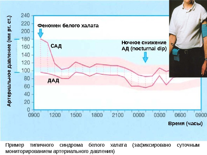 Время (часы)Феномен белого халата Ночное снижение АД ( nocturnal dip ))САДСАД ДАДДАДА р те