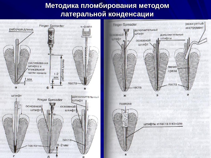 Термофил методика пломбирования. Латерально в стоматологии. Пломбирование каналов латеральной конденсацией методика. Пломбирование обтурация методом латеральной конденсации. Латерально в стоматологии.