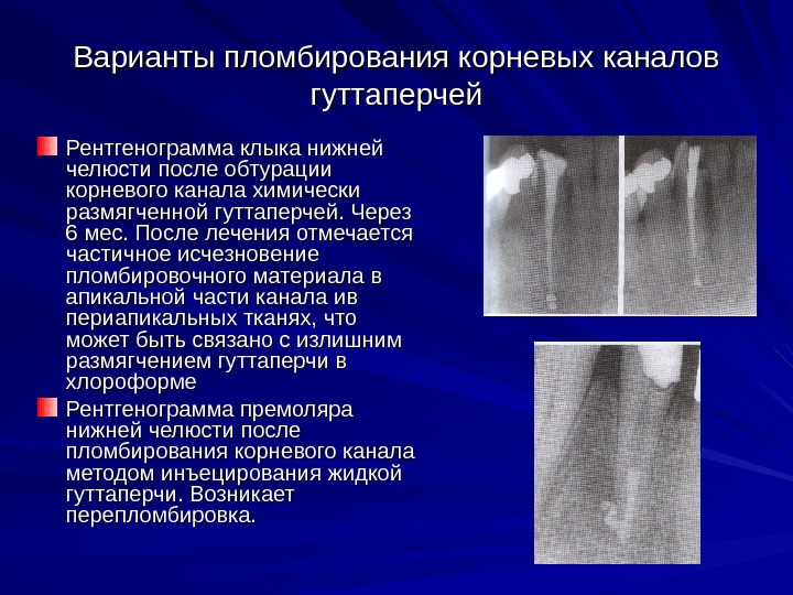 Варианты пломбирования корневых каналов гуттаперчей Рентгенограмма клыка нижней челюсти после обтурации корневого канала химически
