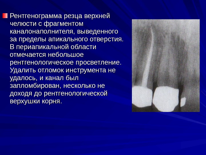 Рентгенограмма резца верхней челюсти с фрагментом каналонаполнителя, выведенного за пределы апикального отверстия.  В