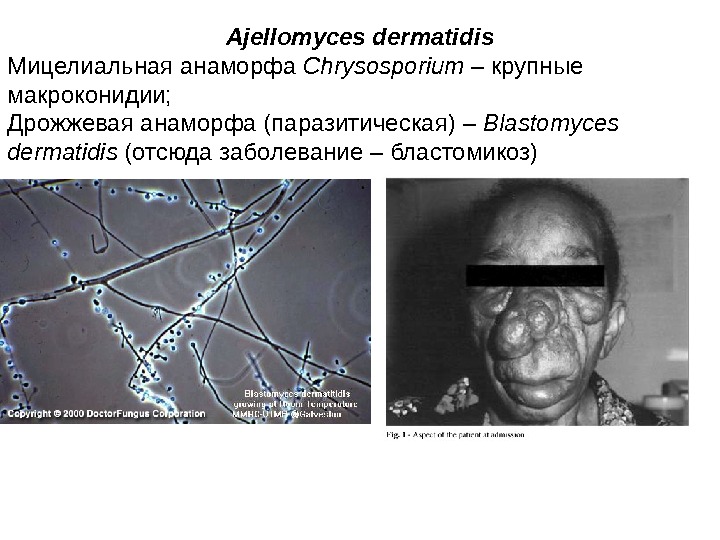   Ajellomyces dermatidis Мицелиальная анаморфа Chrysosporium –  крупные макроконидии; Дрожжевая анаморфа (паразитическая)