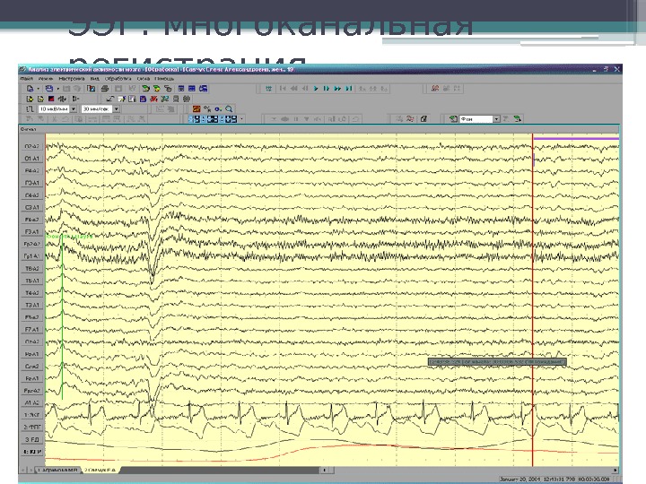ЭЭГ: многоканальная регистрация     