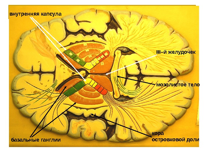 внутренняя капсула базальные ганглии III –й желудочек мозолистое тело кора островковой доли 