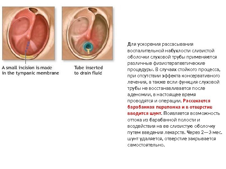 Для ускорения рассасывания воспалительной набухлости слизистой оболочки слуховой трубы применяются различные физиотерапевтические процедуры. В случаях стойкого