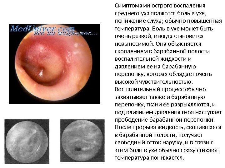Симптомами острого воспаления среднего уха являются боль в ухе,  понижение слуха; обычно повышенная температура. Боль