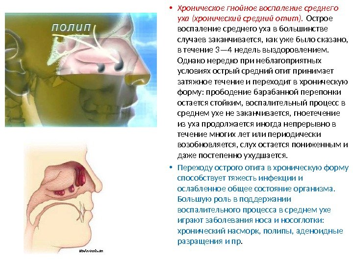  • Хроническое гнойное воспаление среднего уха (хронический средний отит).  Острое воспаление среднего уха в