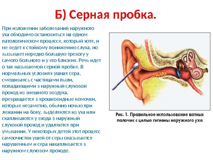 Б) Серная пробка.  При изложении заболеваний наружного уха обходимо остановиться на одном патологическом процессе, который