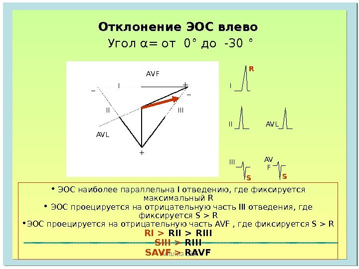 Анализ ЭКГОтклонение ЭОС влево  Угол α = от  0 ° до -30 ° AVF