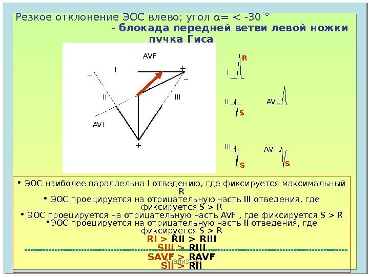 Анализ ЭКГРезкое отклонение ЭОС влево; угол α =   - 30 °   