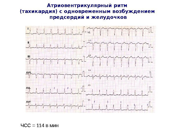 Атриовентрикулярный ритм (тахикардия) с одновременным возбуждением предсердий и желудочков ЧСС = 114 в мин I II