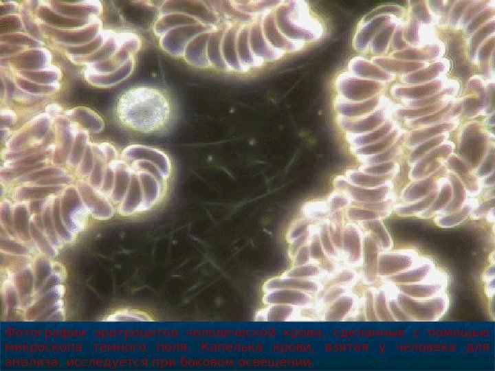   Фотографии эритроцитов человеческой крови,  сделанные с помощью микроскопа темного поля.  Капелька крови,