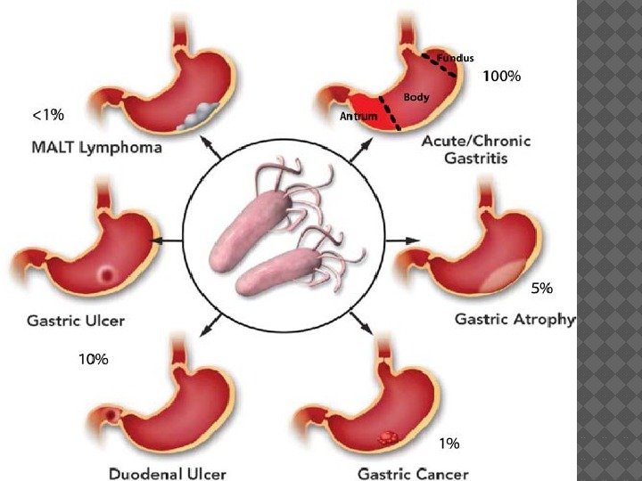 Omeprazol y gastritis atrófica