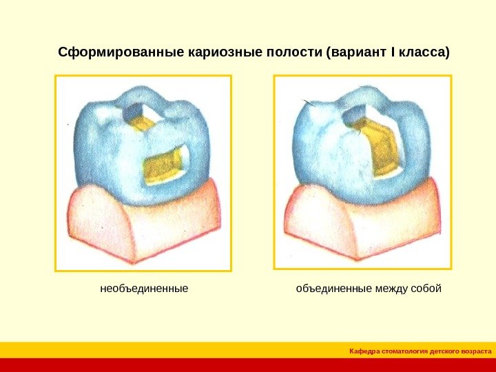 Кафедра стоматология детского возраста. Сформированные кариозные полости (вариант I класса)  необъединенные между собой 