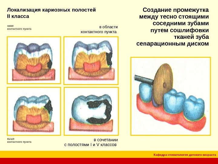 Кафедра стоматология детского возраста. Локализация  кариозных полостей II класса в области контактного пункта ниже контактного