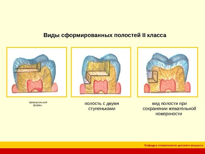 Кафедра стоматология детского возраста. Виды сформированных полостей II класса прямоугольной формы полость с двумя  ступеньками
