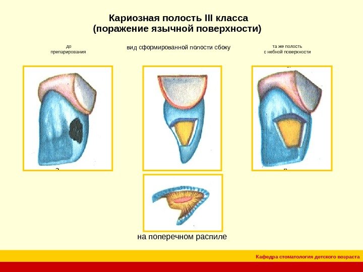Кафедра стоматология детского возраста. Кариозная полость III класса (поражение язычной поверхности) до препарирования вид сформированной полости