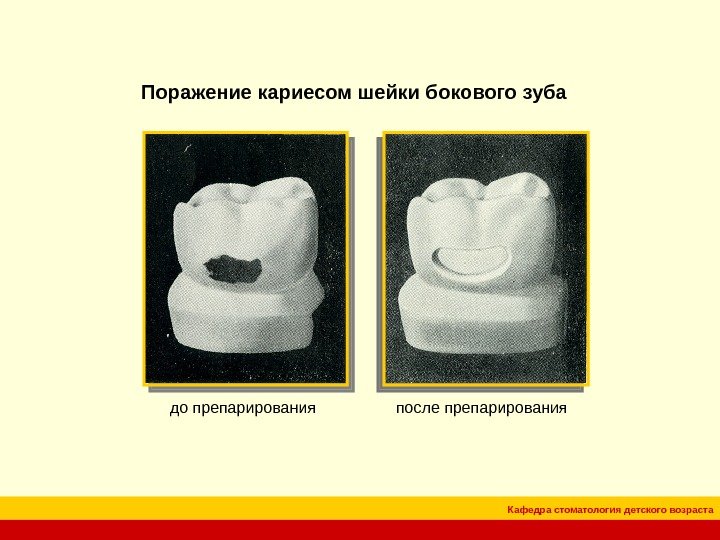 Кафедра стоматология детского возраста. Поражение кариесом шейки бокового зуба до препарирования после препарирования 
