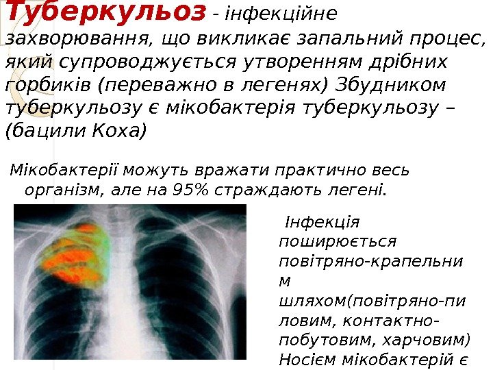 Туберкульоз  - інфекційне захворювання, що викликає запальний процес,  який супроводжується утворенням дрібних горбиків (переважно