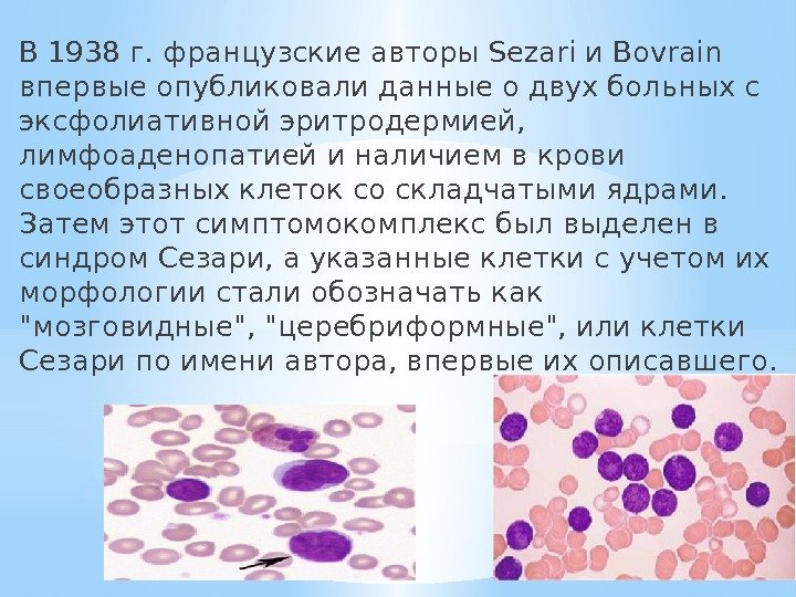 В 1938 г. французские авторы Sezari и Bovrain впервые опубликовали данные о двух больных с эксфолиативной