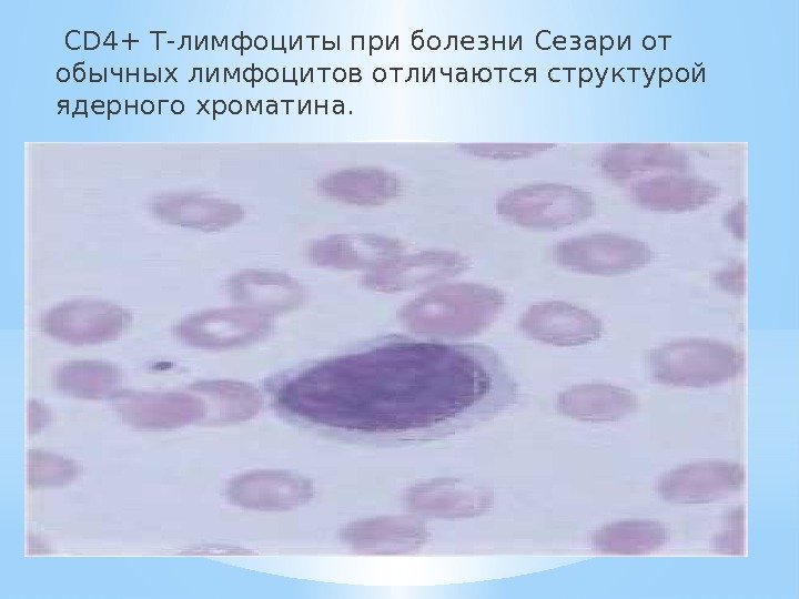  CD 4+ Т-лимфоциты при болезни Сезари от обычных лимфоцитов отличаются структурой ядерного хроматина. 