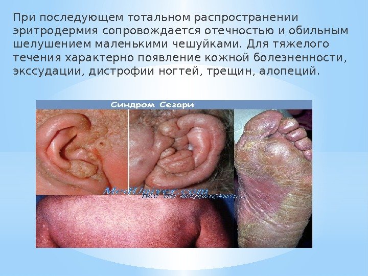 При последующем тотальном распространении эритродермия сопровождается отечностью и обильным шелушением маленькими чешуйками. Для тяжелого течения характерно