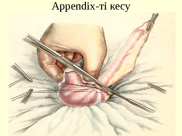 Appendix -ті кесу 