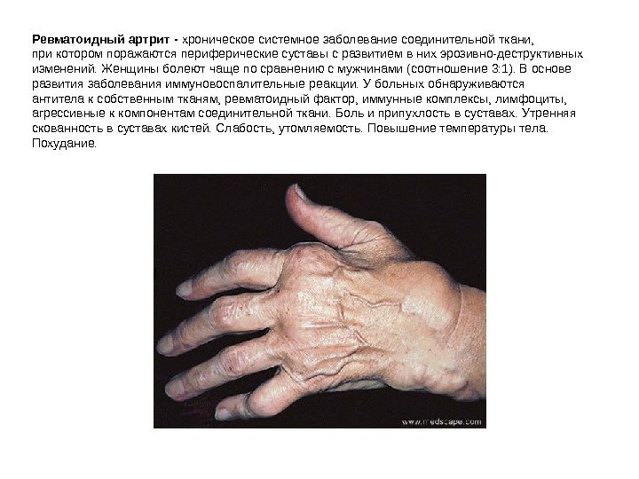 Ревматоидный артрит - хроническое системное заболевание соединительной ткани,  при котором поражаются  периферические суставы с