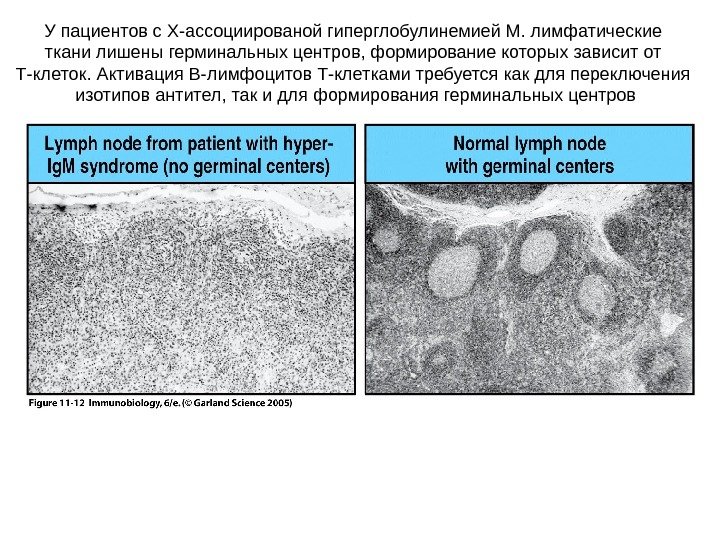 У пациентов с X- ассоциированой гиперглобулинемией M. лимфатические ткани лишены герминальных центров, формирование которых зависит от