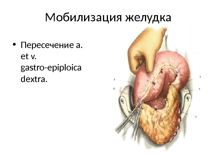 Бильрот 1 и 2 схема