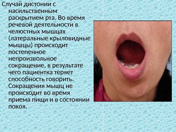 Случай дистонии с насильственным раскрытием рта. Во время речевой деятельности в челюстных мышцах (латеральные крыловидные мышцы)