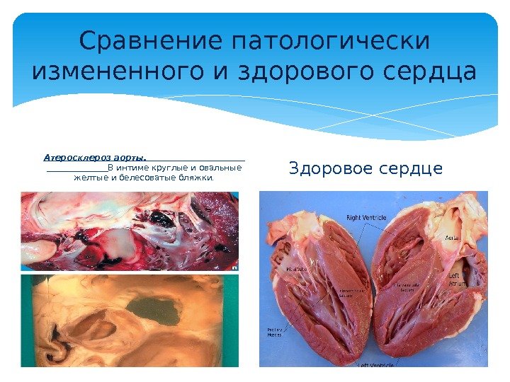 Сравнение патологически измененного и здорового сердца Атеросклероз аорты.     В интиме круглые и