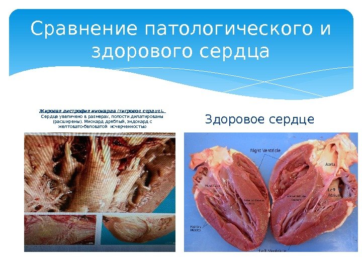 Сравнение патологического и здорового сердца Жировая дистрофия миокарда (тигровое сердце).  Сердце увеличено в размерах, полости
